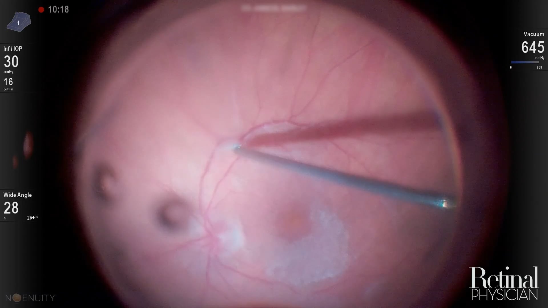 Visualization for Vitrectomy, video 1