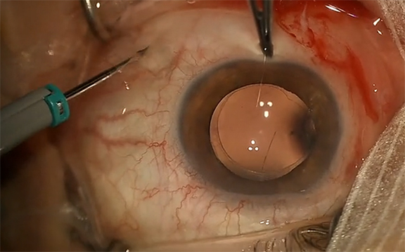 Surgical Posterior Capsulectomy