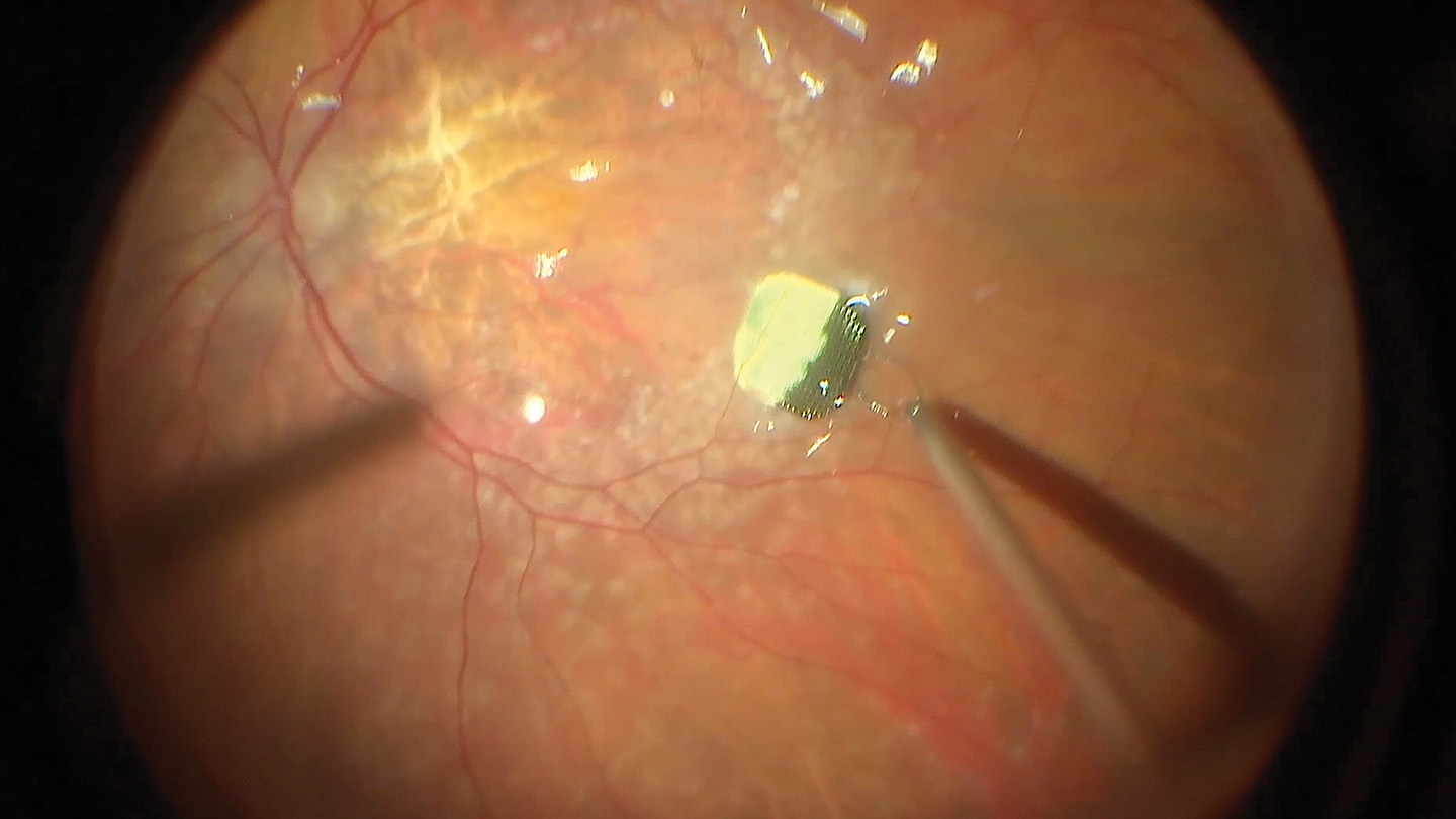 Surgical Roundtable Case 4: Implanting a Subretinal Photovoltaic Prosthesis
